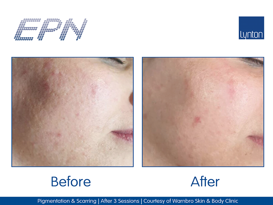 EPN-Microneedling